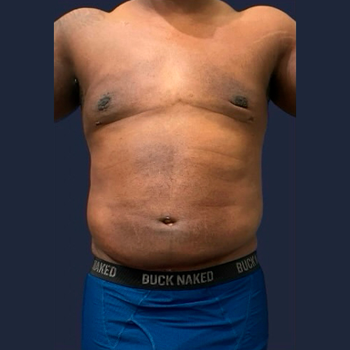 01---Post-Op-Care--a
