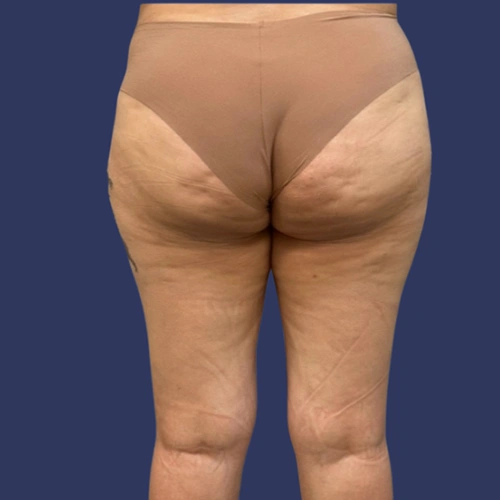 Body contour - 01-v1