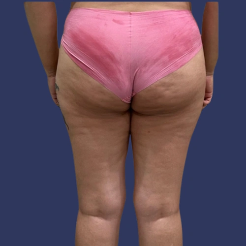 Body contour - 01-v2