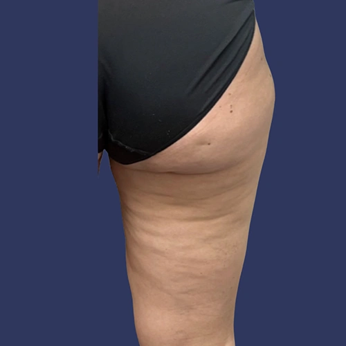 Body contour - 03-v1