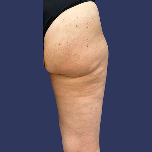 Body contour - 03-v2