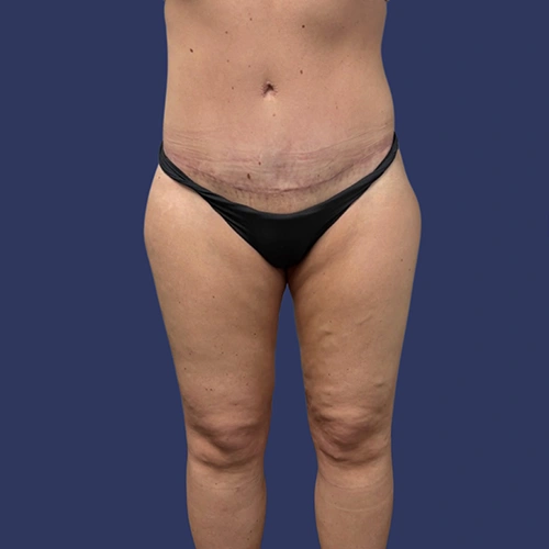 Body contour - 05-v1