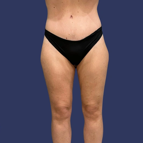 Body contour - 05-v2