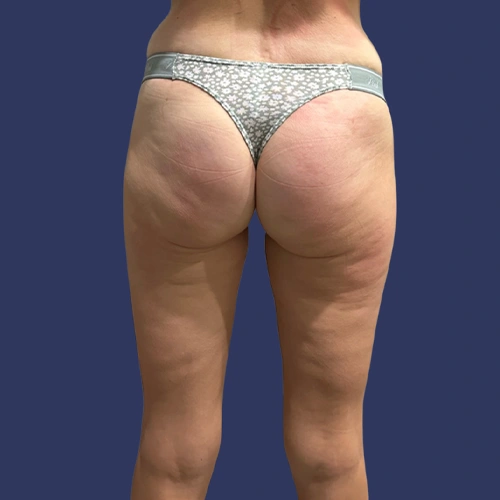 Body contour - 10-v1
