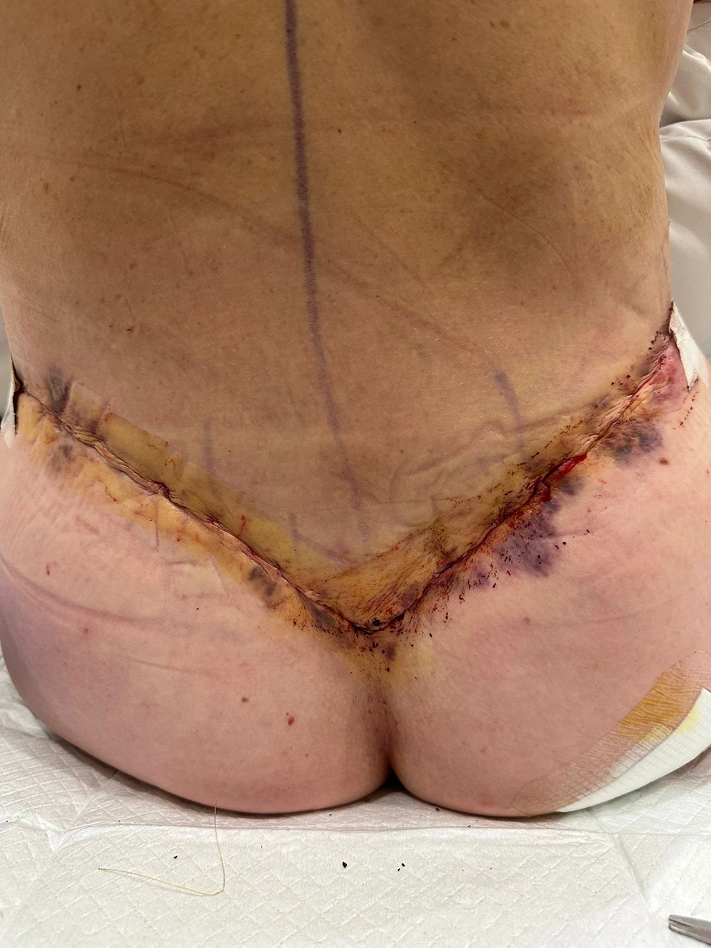 01 - 24 hours post-op