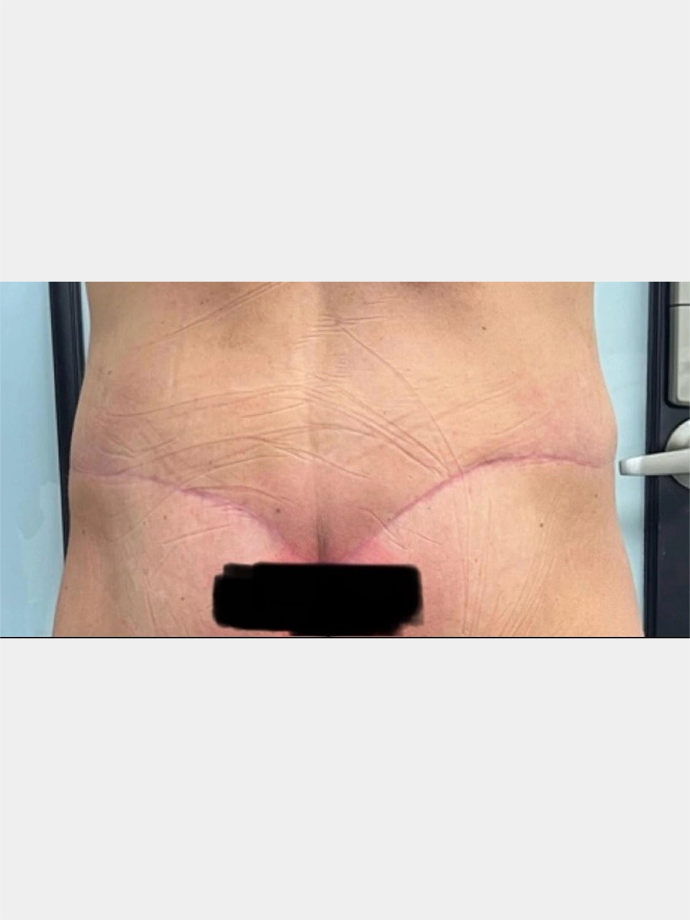 04- 6 weeks post-op