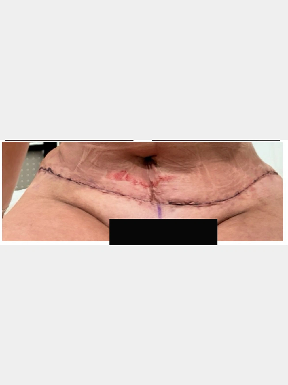 05 - 24 hours post-op