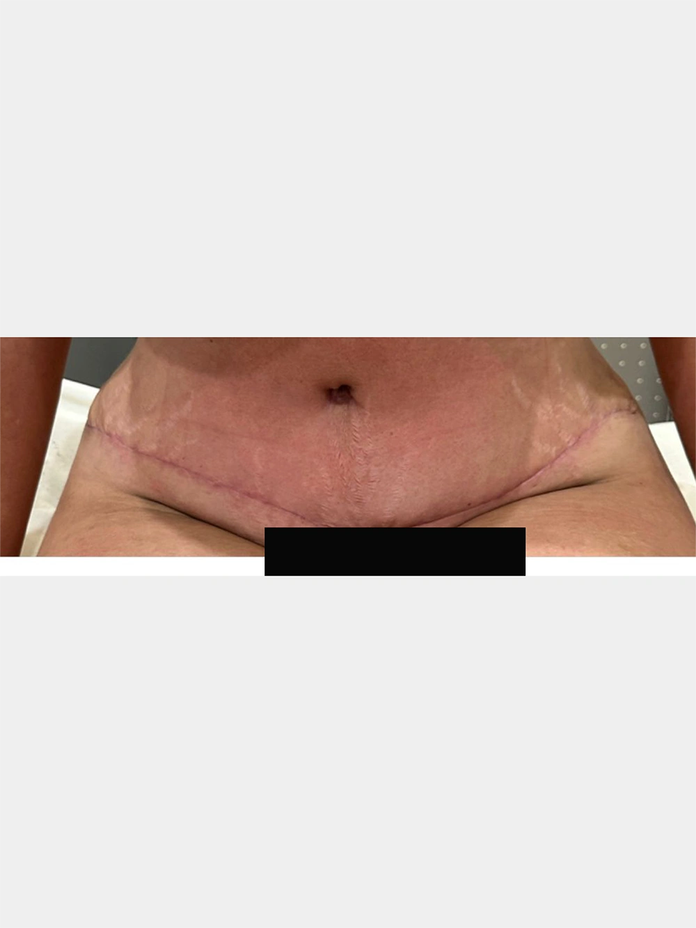 06 - 6 weeks post-op