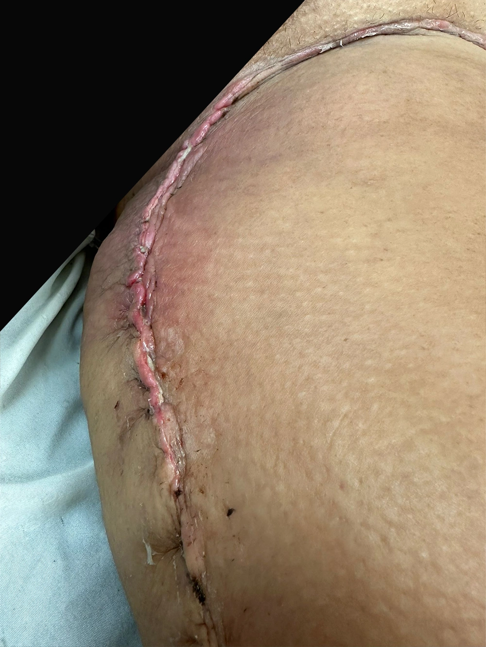 01- 14 days post-op