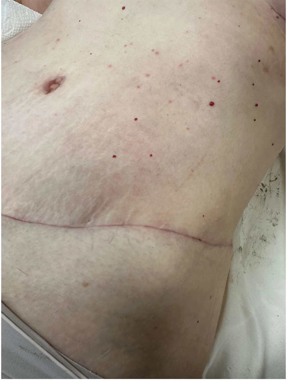 05 - See tb 6 weeks post-op