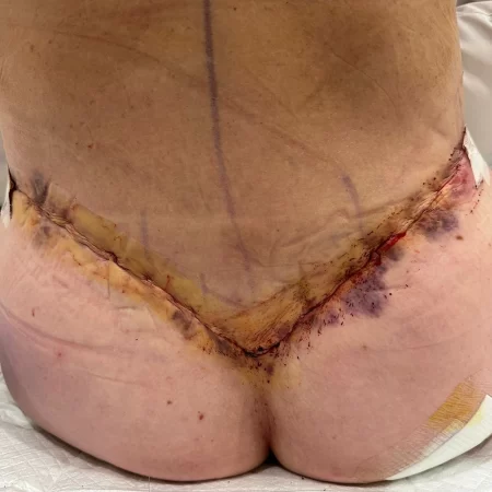 01 - 24 hours post-op