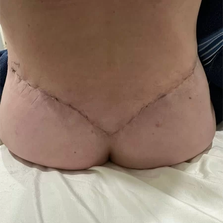 03 - 3 weeks post-op