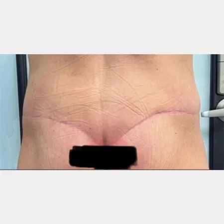 04- 6 weeks post-op