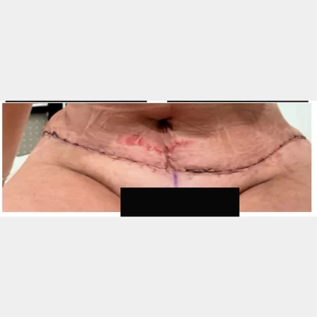 05 - 24 hours post-op