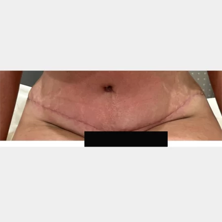 06 - 6 weeks post-op