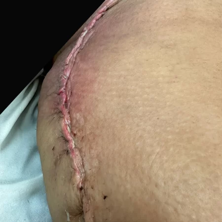 01- 14 days post-op