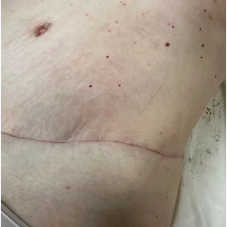 05 - See tb 6 weeks post-op